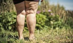 Lipodem nedir?